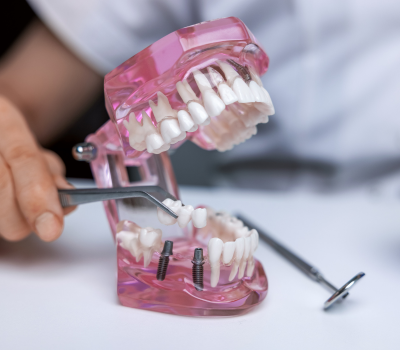 Dental Bridge